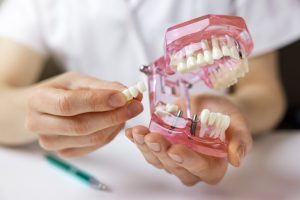implantów stomatologicznych